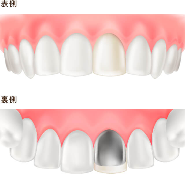 硬質レジン前装冠のイラスト