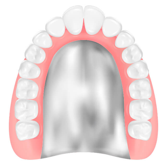 コバルトクロム床義歯のイラスト
