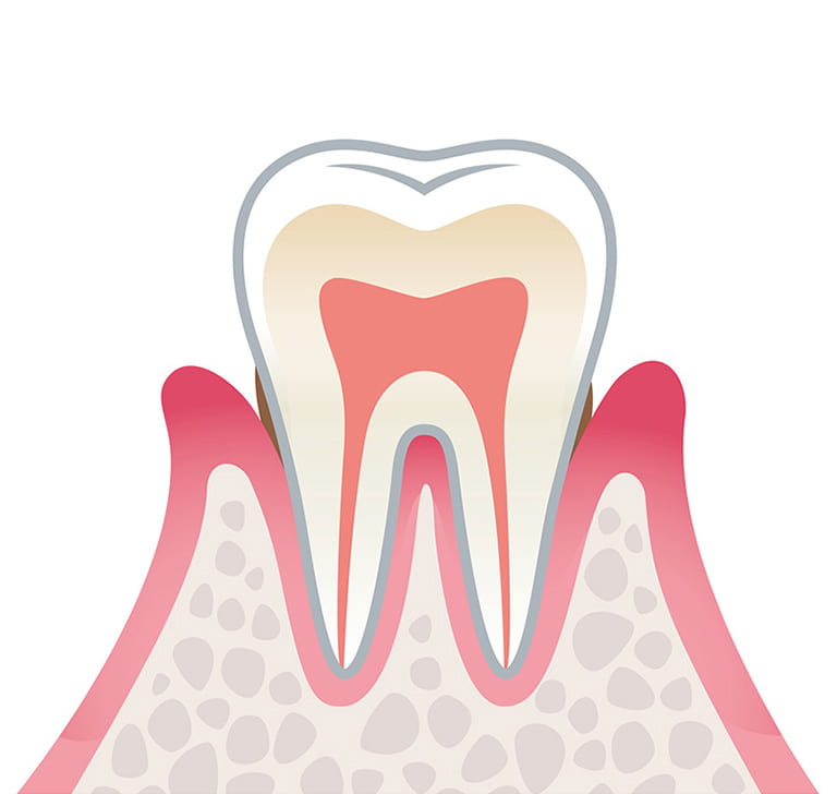 歯周病軽度のイラスト