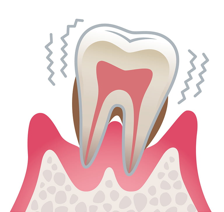 歯周病重度のイラスト