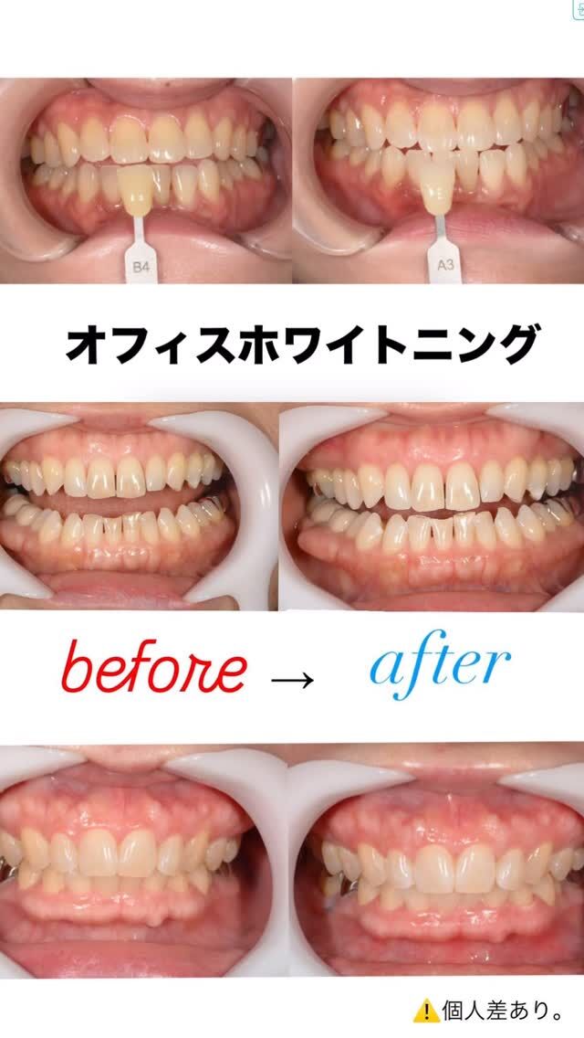 オフィスホワイトニング🦷